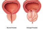 prostates